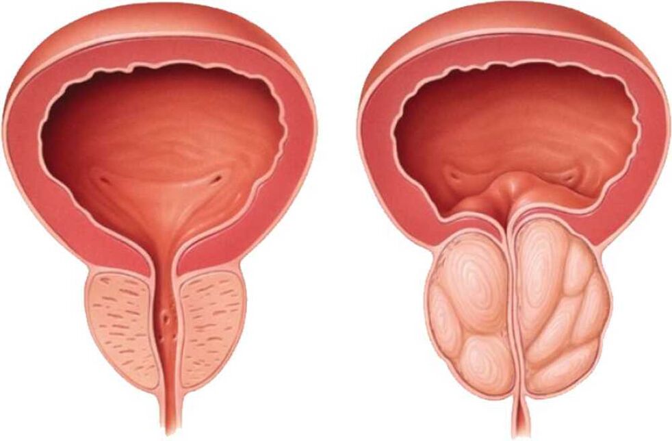 prostate douloureuse